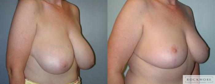 Before & After Breast Reduction Case 62 View #2 View in Albany & Latham, New York