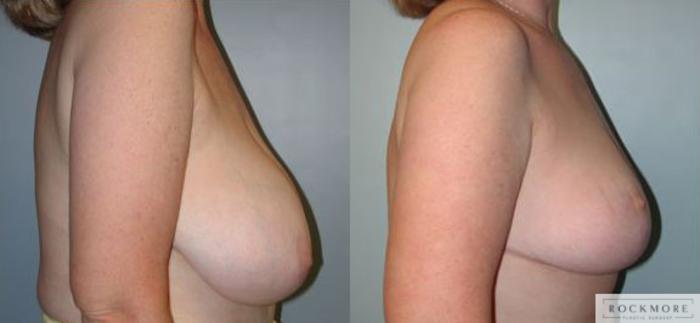 Before & After Breast Reduction Case 62 View #3 View in Albany & Latham, New York