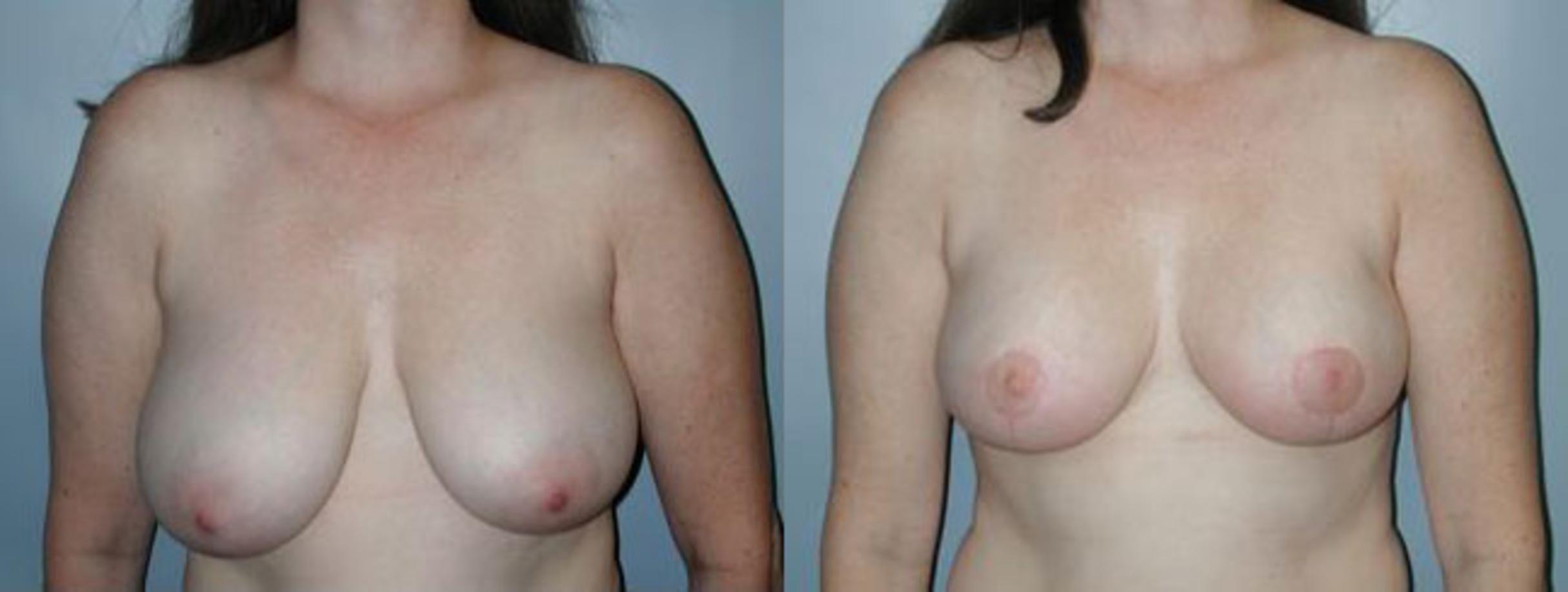 Before & After Breast Reduction Case 91 View #1 View in Albany, Latham & Saratoga, New York