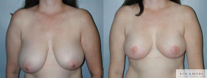Before & After Breast Reduction Case 91 View #1 View in Albany & Latham, New York