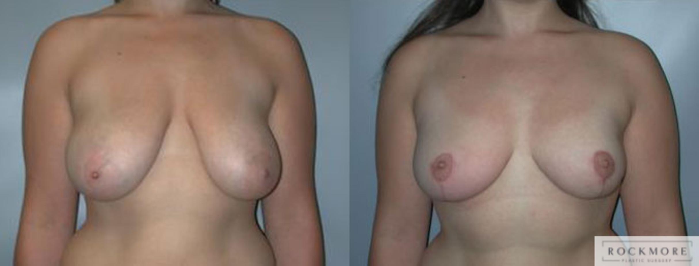Before & After Breast Reduction Case 92 View #1 View in Albany & Latham, New York