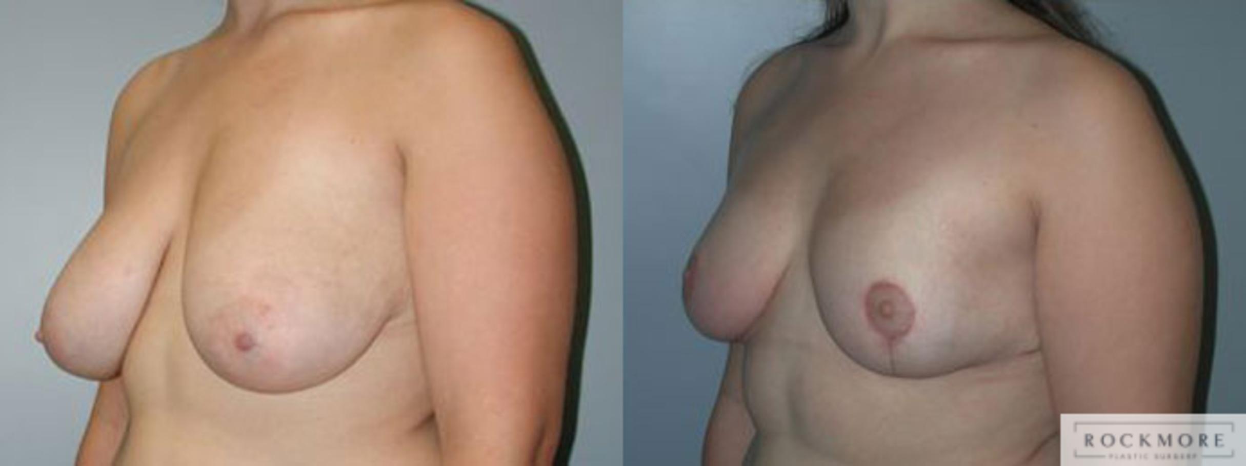 Before & After Breast Reduction Case 92 View #2 View in Albany & Latham, New York