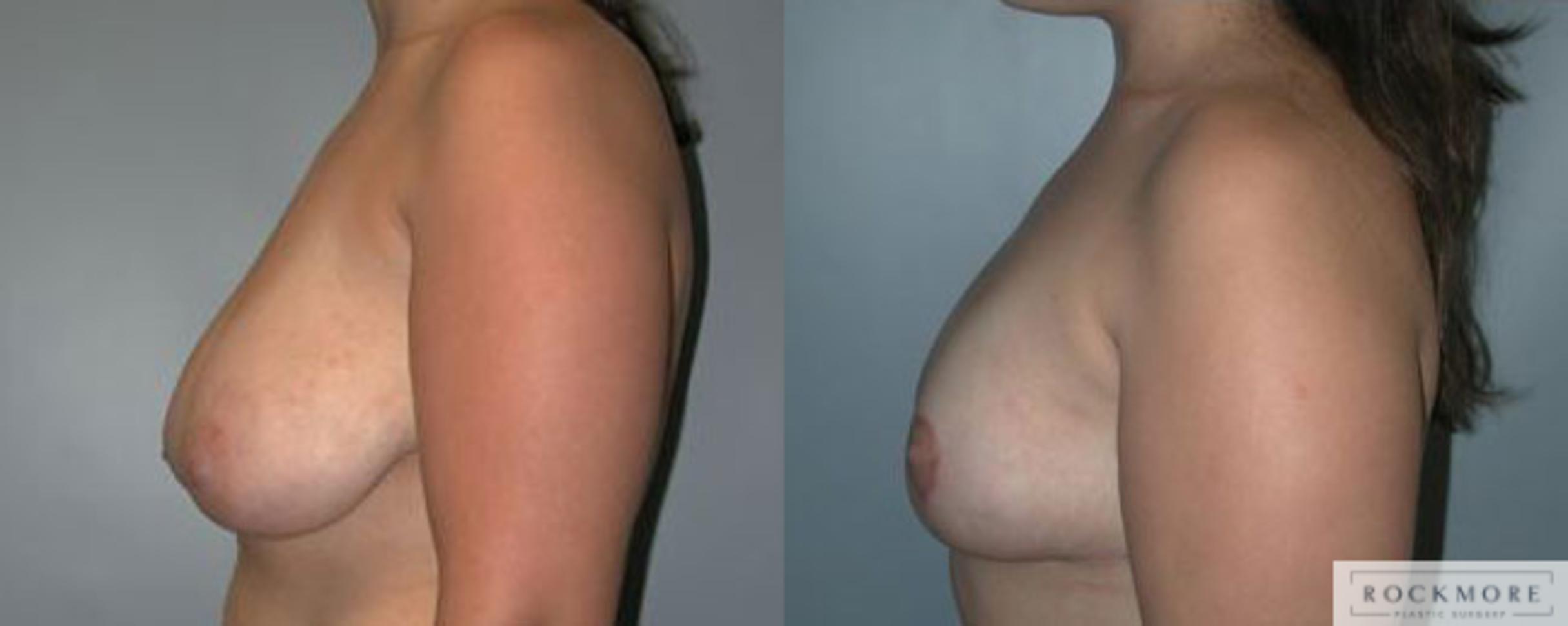 Before & After Breast Reduction Case 92 View #3 View in Albany & Latham, New York