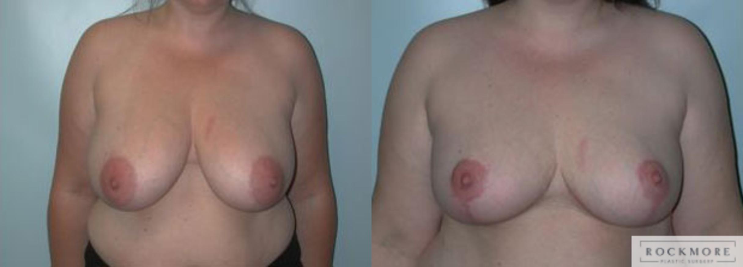 Before & After Breast Reduction Case 95 View #1 View in Albany & Latham, New York