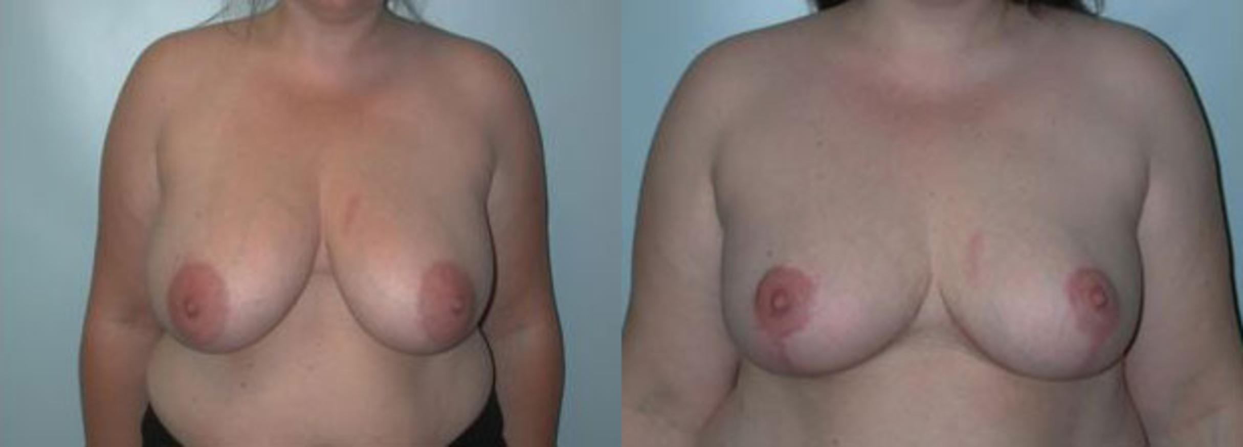 Before & After Breast Reduction Case 95 View #1 View in Albany & Latham, New York