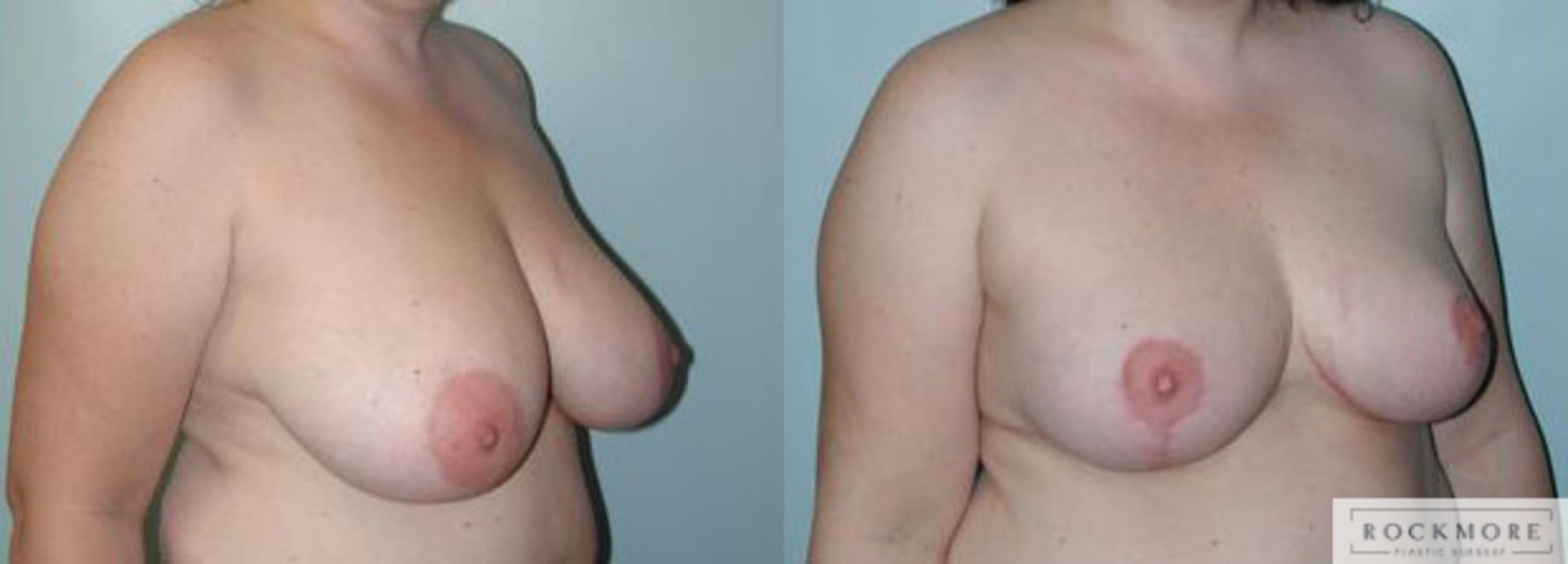 Before & After Breast Reduction Case 95 View #2 View in Albany & Latham, New York