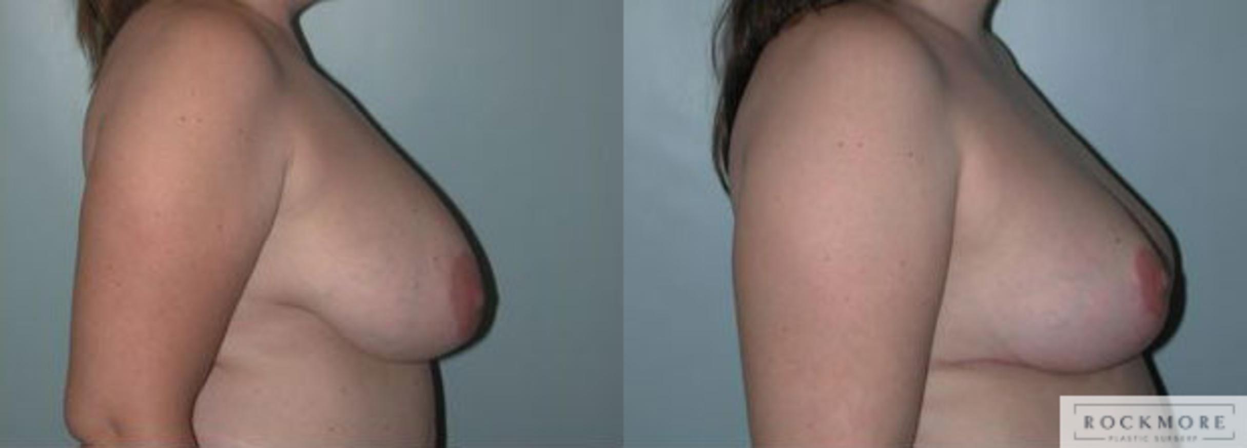 Before & After Breast Reduction Case 95 View #3 View in Albany & Latham, New York