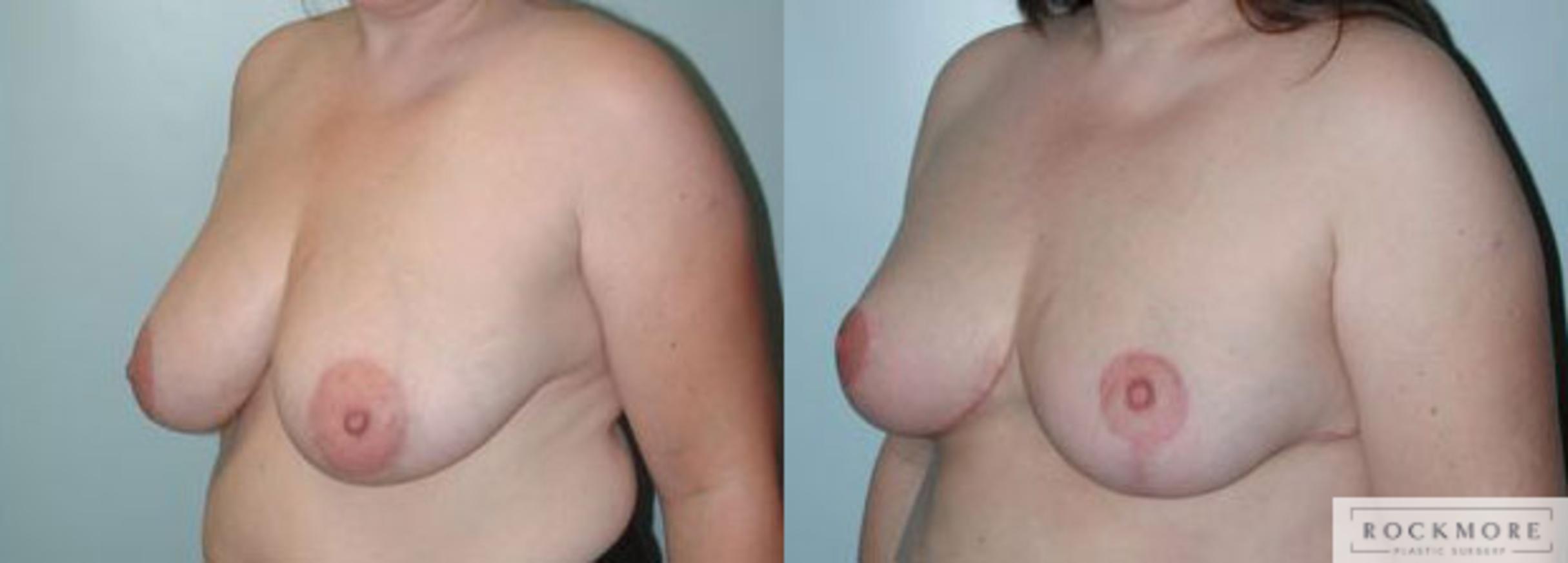 Before & After Breast Reduction Case 95 View #4 View in Albany & Latham, New York