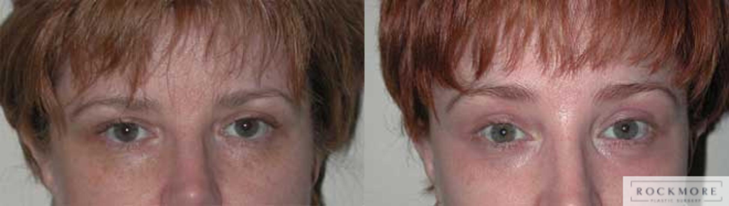Before & After Brow Lift Case 14 View #1 View in Albany & Latham, New York