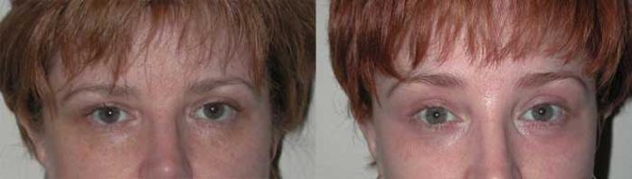 Before & After Brow Lift Case 14 View #1 View in Albany, Latham & Saratoga, New York