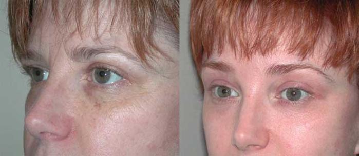 Before & After Brow Lift Case 14 View #2 View in Albany, Latham & Saratoga, New York