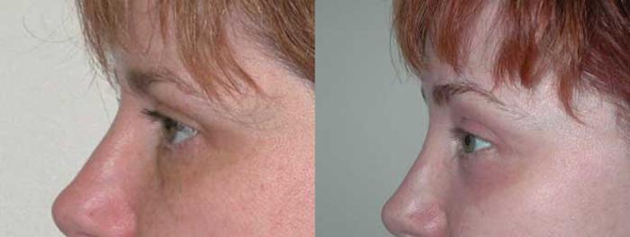 Before & After Brow Lift Case 14 View #3 View in Albany, Latham & Saratoga, New York