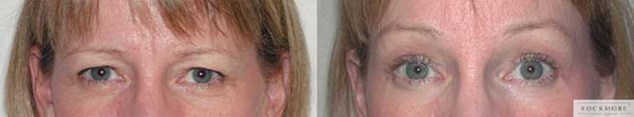 Before & After Brow Lift Case 15 View #1 View in Albany & Latham, New York
