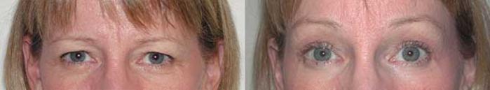 Before & After Brow Lift Case 15 View #1 View in Albany, Latham & Saratoga, New York