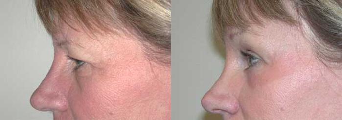 Before & After Brow Lift Case 15 View #2 View in Albany, Latham & Saratoga, New York