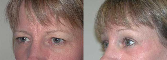 Before & After Brow Lift Case 15 View #3 View in Albany, Latham & Saratoga, New York