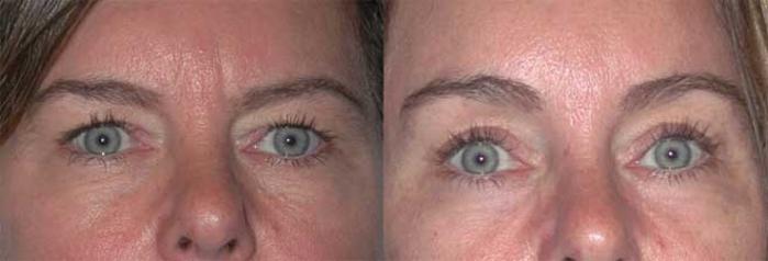 Before & After Brow Lift Case 17 View #1 View in Albany, Latham & Saratoga, New York