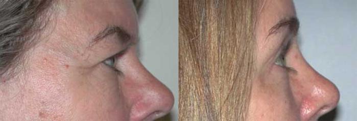 Before & After Brow Lift Case 17 View #2 View in Albany, Latham & Saratoga, New York