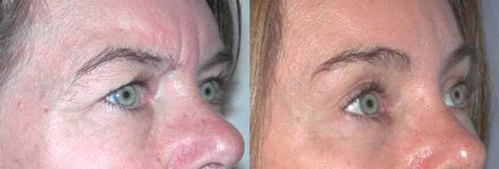 Before & After Brow Lift Case 17 View #3 View in Albany, Latham & Saratoga, New York