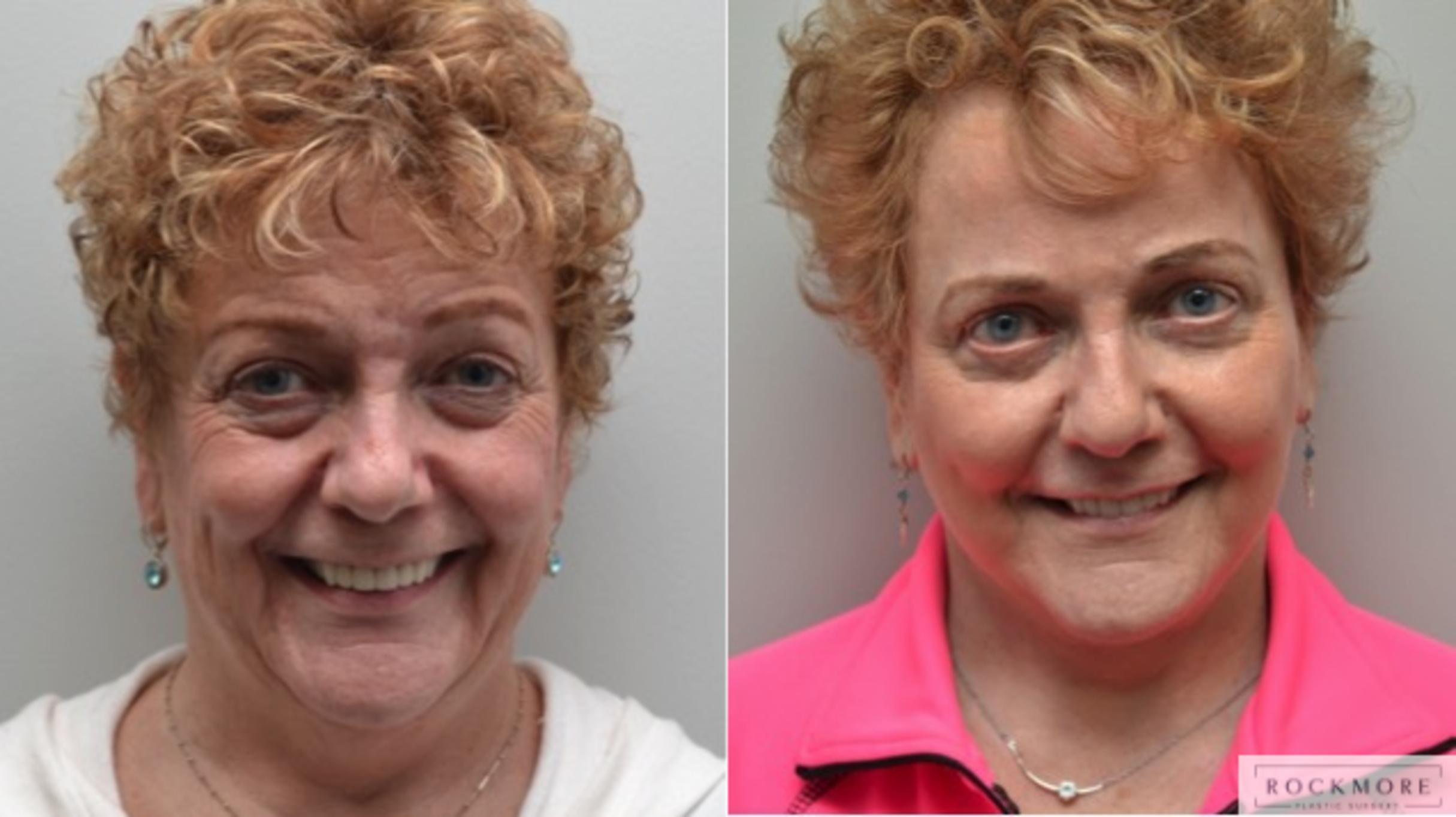 Before & After Brow Lift Case 282 View #1 View in Albany & Latham, New York