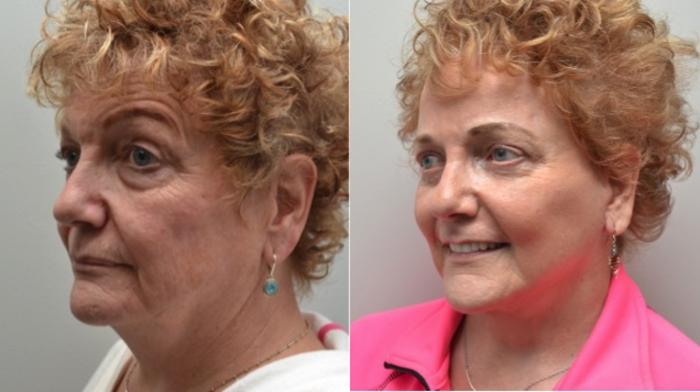 Before & After Facelift Case 282 View #3 View in Albany, Latham & Saratoga, New York