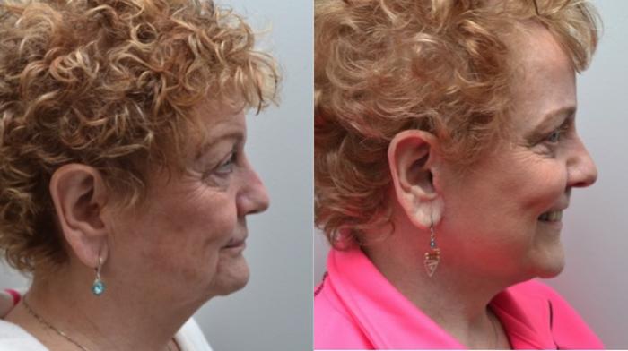 Before & After Facelift Case 282 View #4 View in Albany, Latham & Saratoga, New York