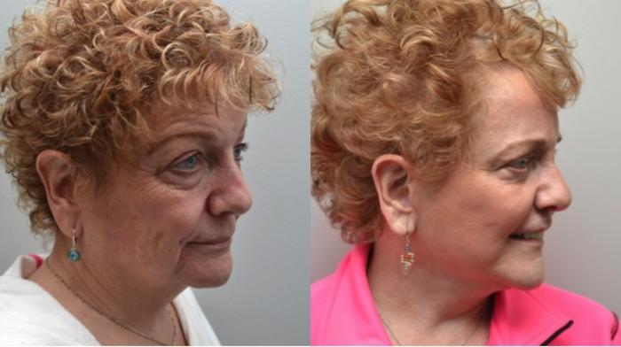 Before & After Facelift Case 282 View #5 View in Albany, Latham & Saratoga, New York