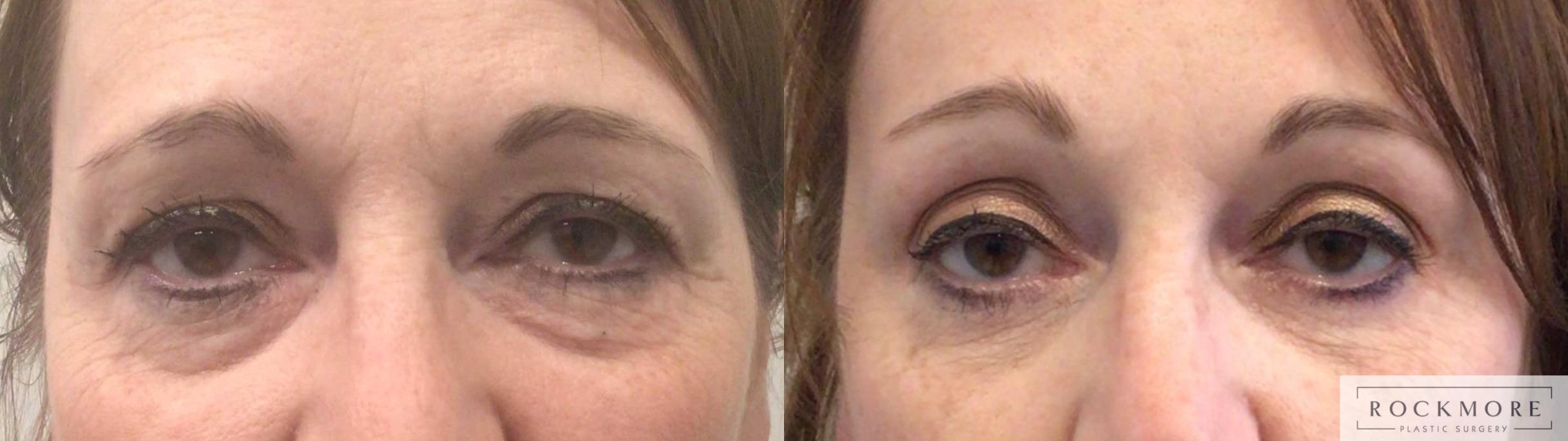 Before & After Eyelid Surgery Case 444 Front View in Albany & Latham, New York