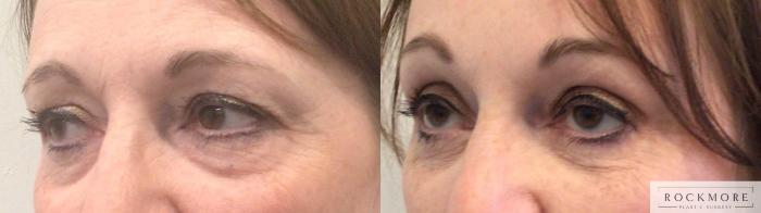 Before & After Eyelid Surgery Case 444 Left Side View in Albany & Latham, New York