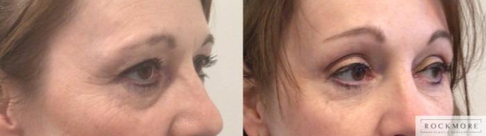 Before & After Eyelid Surgery Case 444 Right Side View in Albany & Latham, New York