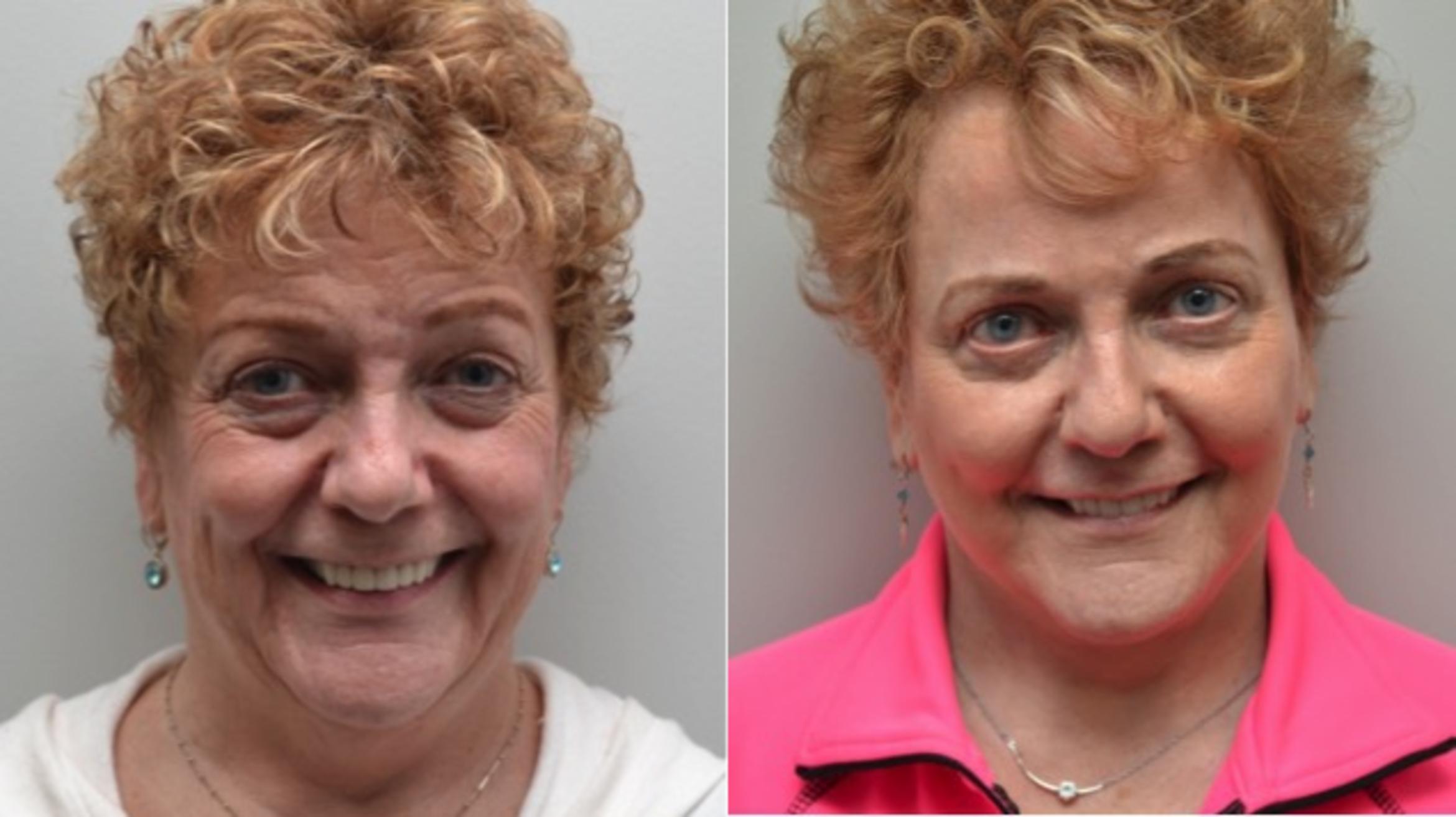 Before & After Facelift Case 282 View #1 View in Albany & Latham, New York