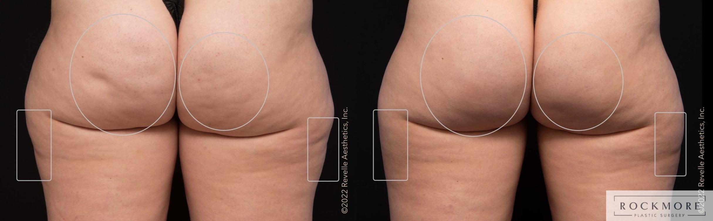 Before & After Cellulite Case 466 Back View in Albany & Latham, New York