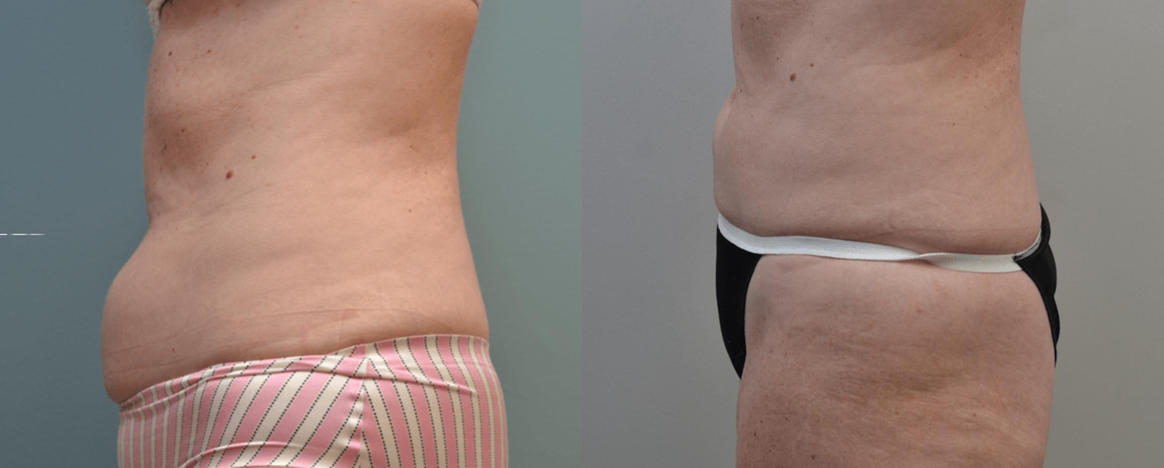 Before & After Non-Invasive Fat Removal Case 170 View #1 View in Albany & Latham, New York
