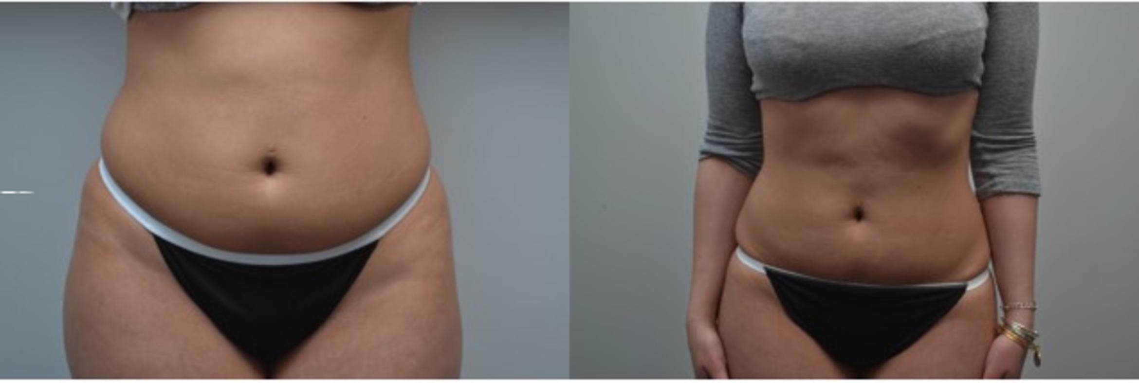 Before & After Non-Invasive Fat Removal Case 262 View #1 View in Albany & Latham, New York