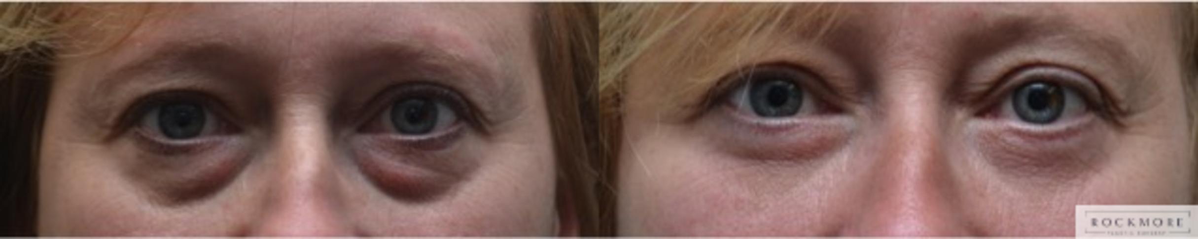 Before & After Eyelid Surgery Case 265 View #1 View in Albany & Latham, New York