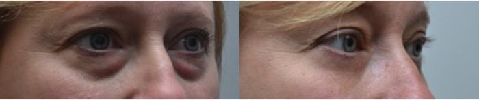 Before & After Eyelid Surgery Case 265 View #2 View in Albany, Latham & Saratoga, New York