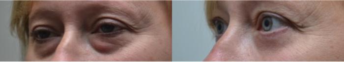 Before & After Eyelid Surgery Case 265 View #3 View in Albany, Latham & Saratoga, New York