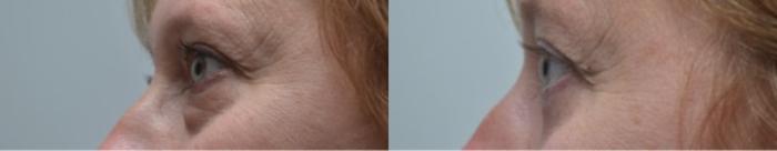 Before & After Eyelid Surgery Case 265 View #4 View in Albany, Latham & Saratoga, New York