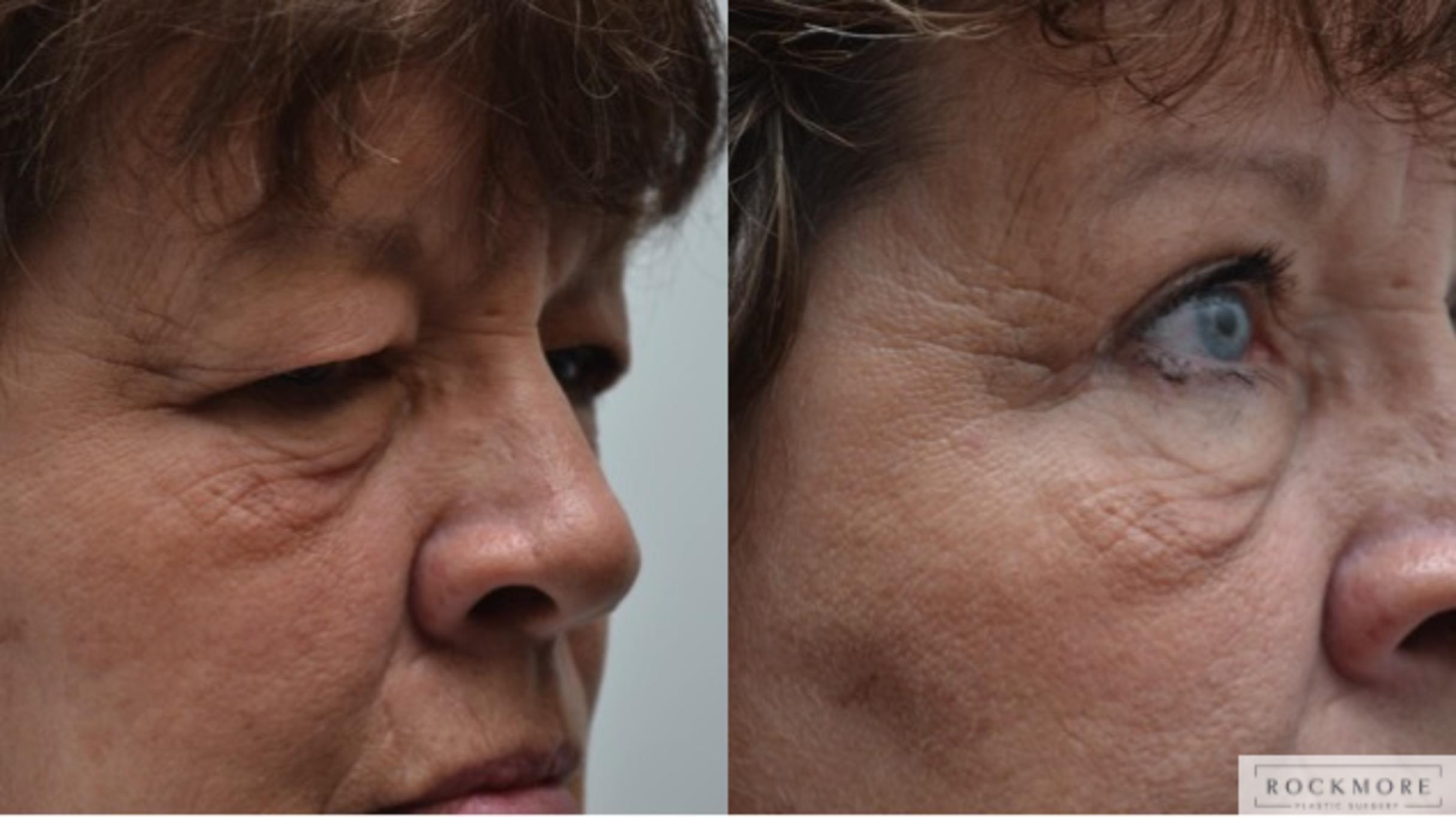 Eyelid Surgery Before & After Photos Patient 266 Latham