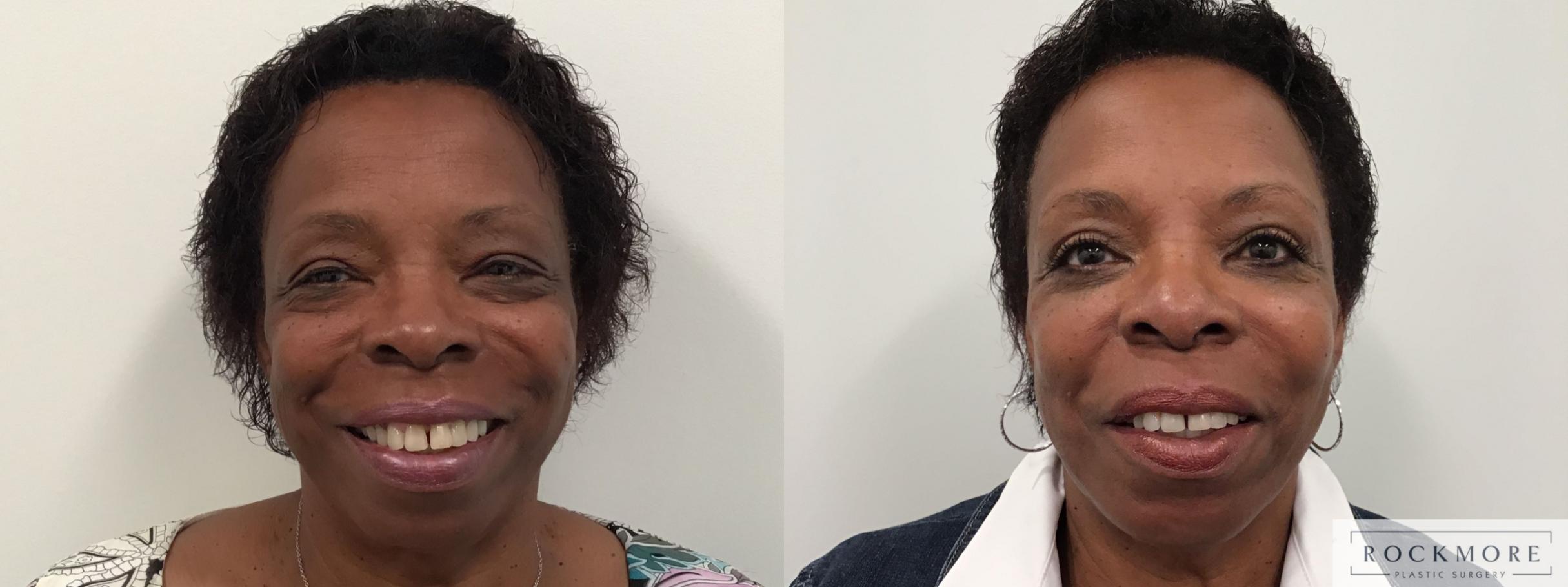 Before & After Eyelid Surgery Case 438 Front View in Albany & Latham, New York