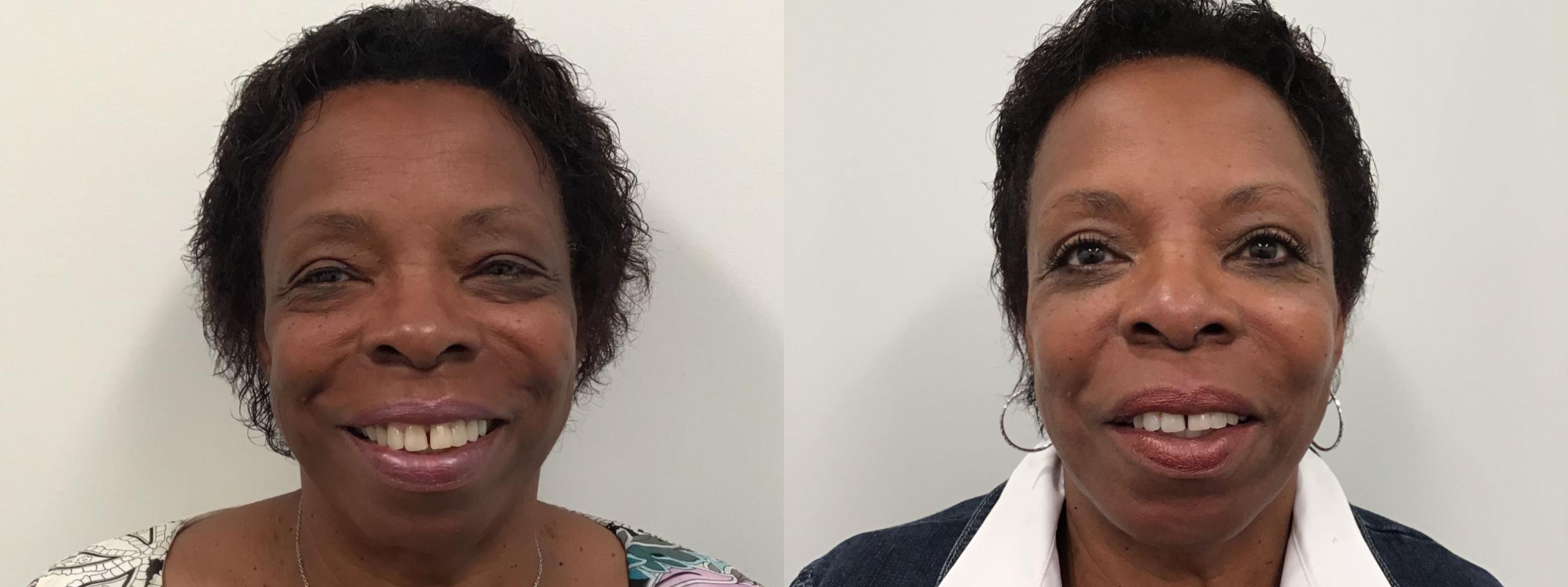 Before & After Eyelid Surgery Case 438 Front View in Albany & Latham, New York