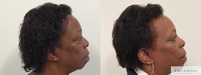 Before & After Eyelid Surgery Case 438 Right Side View in Albany & Latham, New York