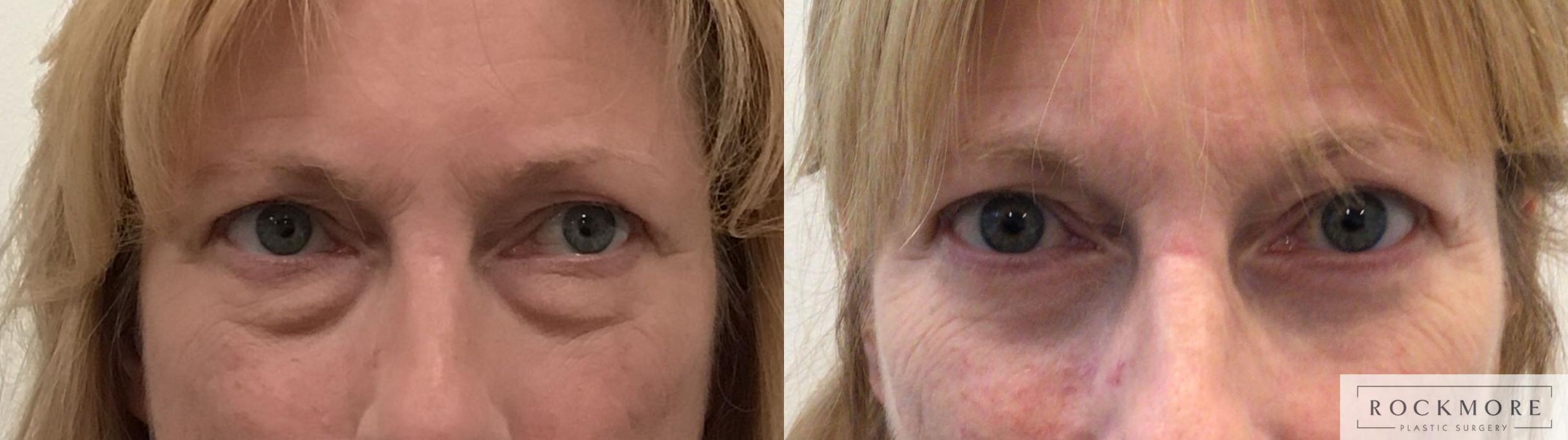 Before & After Eyelid Surgery Case 440 Front View in Albany & Latham, New York