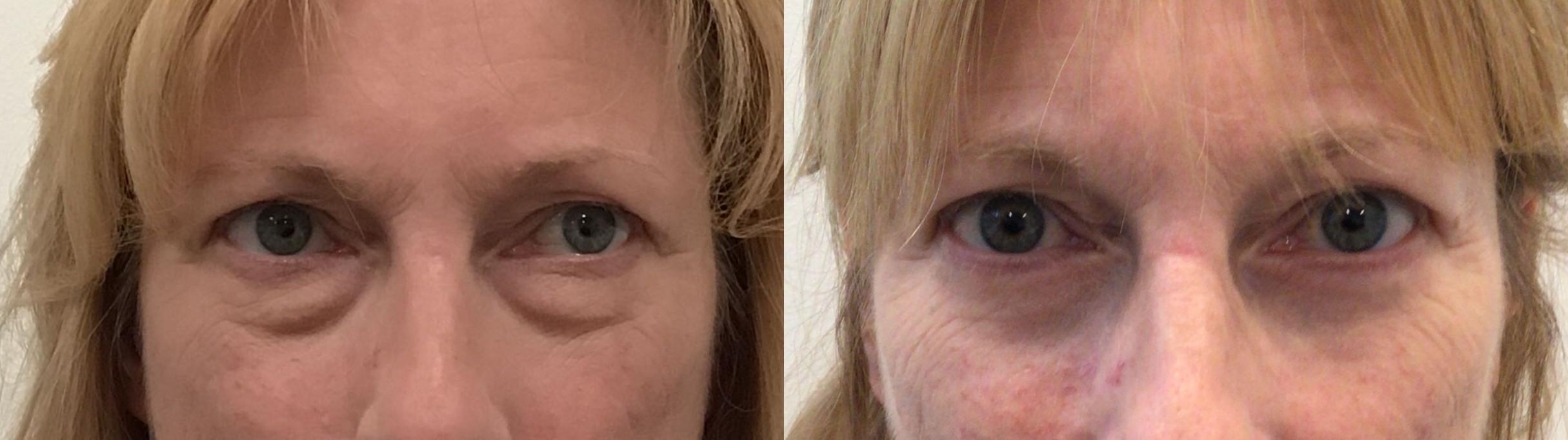 Before & After Eyelid Surgery Case 440 Front View in Albany & Latham, New York