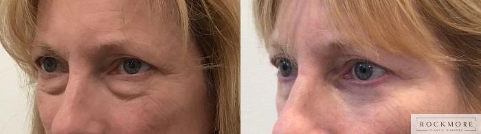 Before & After Eyelid Surgery Case 440 Left Side View in Albany & Latham, New York
