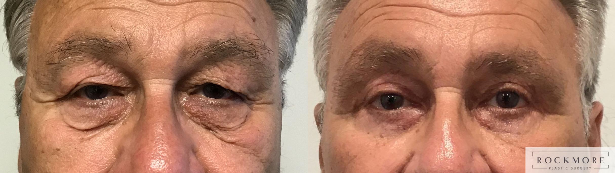 Before & After Eyelid Surgery Case 450 Front View in Albany & Latham, New York