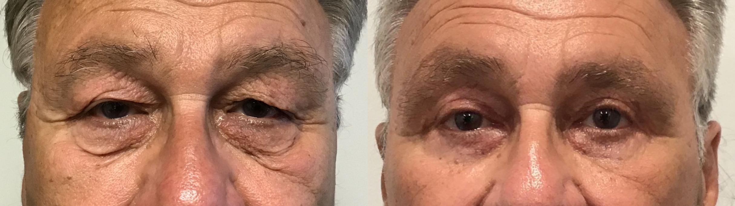 Before & After Eyelid Surgery Case 450 Front View in Albany & Latham, New York