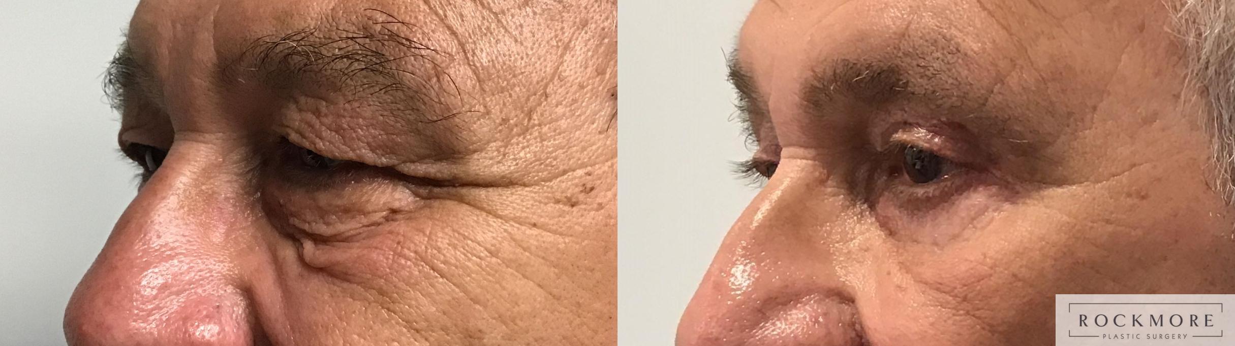 Before & After Eyelid Surgery Case 450 Left Side View in Albany & Latham, New York