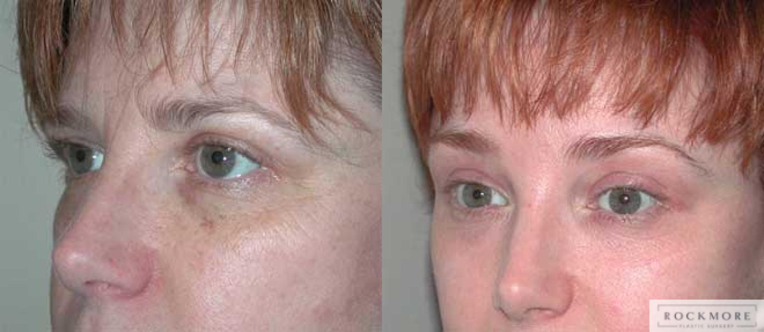 Eyelid Surgery Before & After Photos Patient 51 Albany