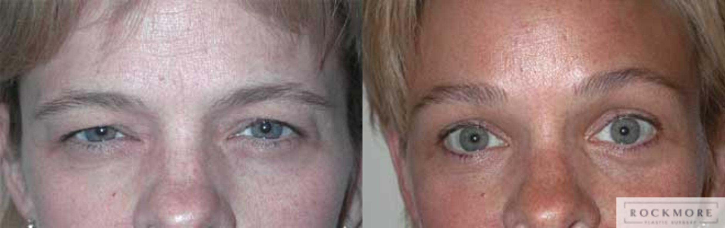 Before & After Eyelid Surgery Case 53 View #1 View in Albany & Latham, New York